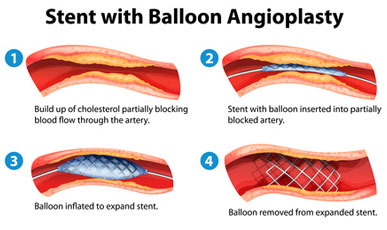 Types of Heart Stents and Their Uses